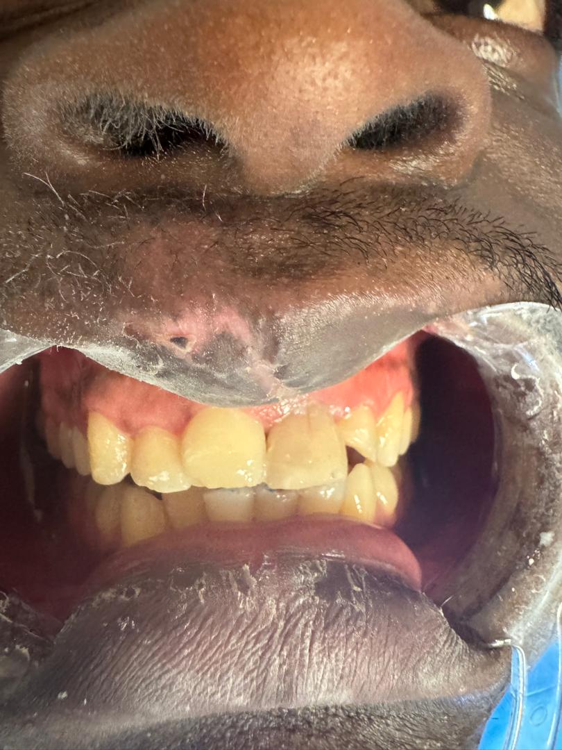 Résultat après la reconstitution des dents 21 et 11